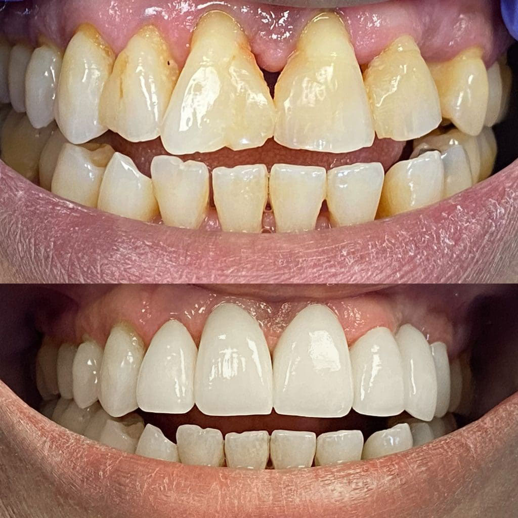 Crown treatment results