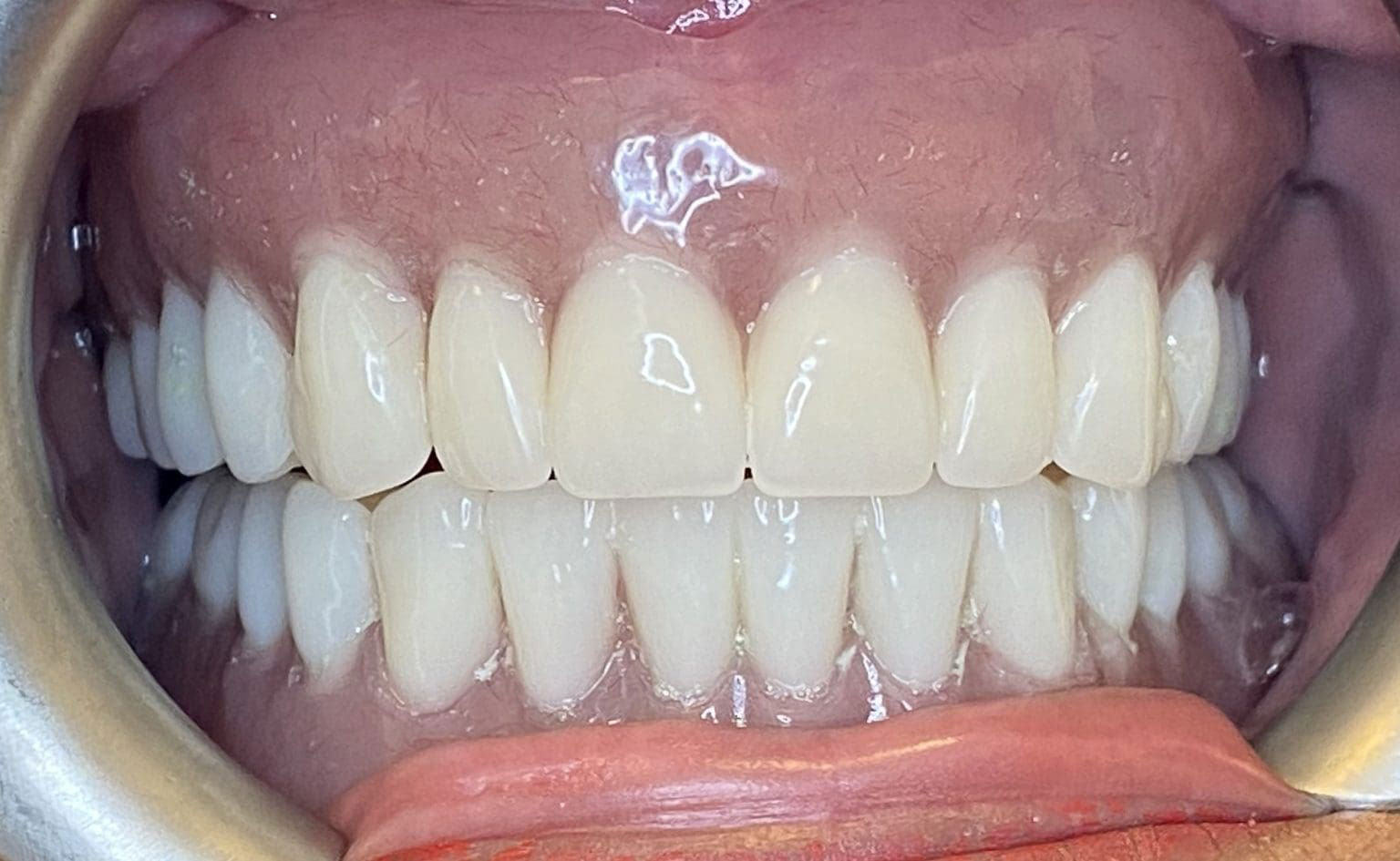 Dorothy dentures transformation